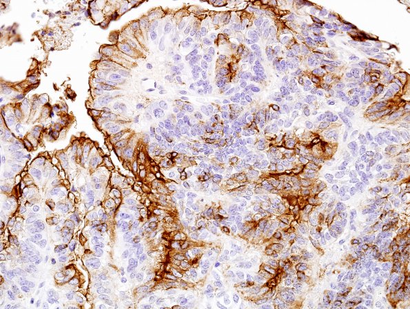 4B5 Meningioma, papillary (Case 4) EMA 10.jpg