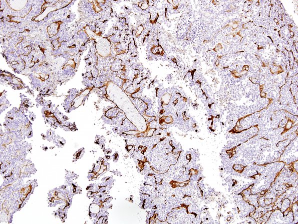 4E1 Meningioma, papillary (Case 4) Coll IV 1.jpg