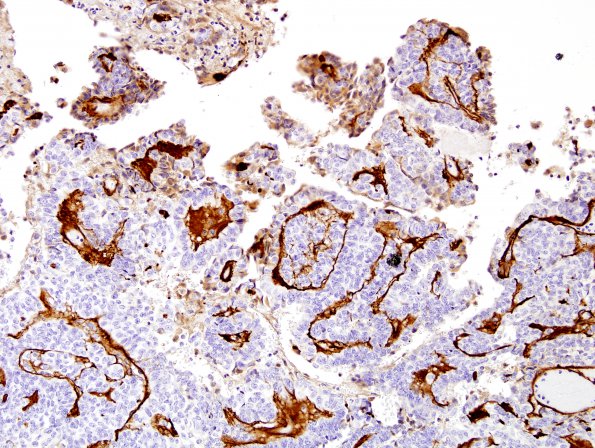 4E3 Meningioma, papillary (Case 4) Coll IV 3.jpg