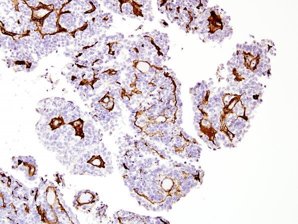 4E4 Meningioma, papillary (Case 4) Coll IV 2.jpg