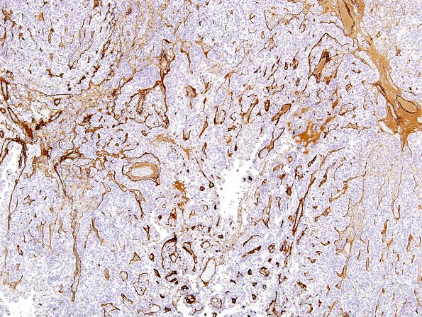 4E5 Meningioma, papillary (Case 4) Coll IV 6.jpg