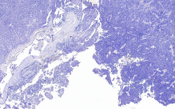 5A1 Meningioma, papillary (Case 5) Antibody Negative prep 4X