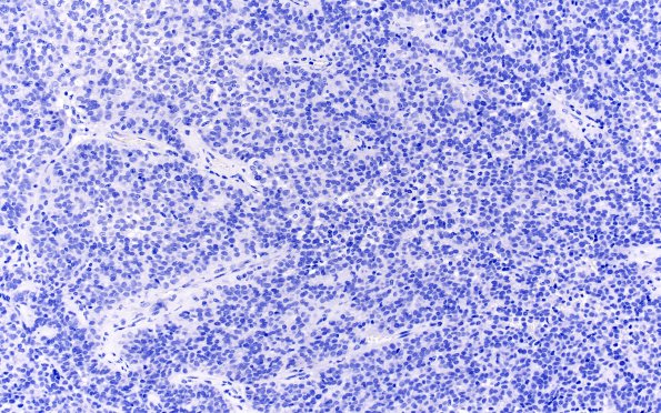 5A2 Meningioma, papillary (Case 5) Antibody Negative prep 20X