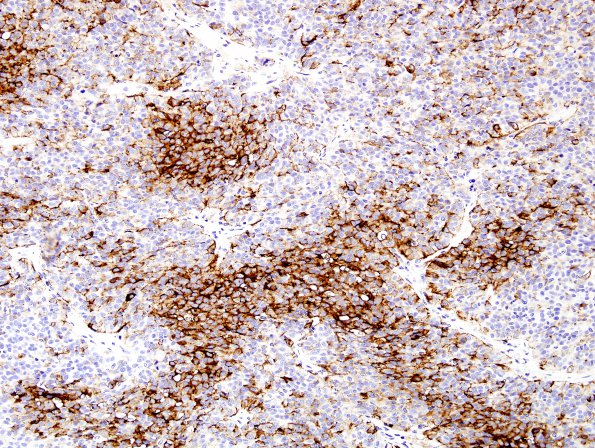 5B2 Meningioma, papillary (Case 5) EMA 3.jpg