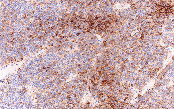 5B4 Meningioma, papillary (Case 5) EMA 20X 3