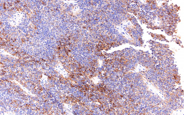 5B5 Meningioma, papillary (Case 5) EMA 20X