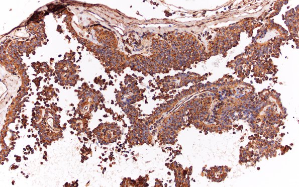 5B6 Meningioma, papillary (Case 5) EMA 20X 2