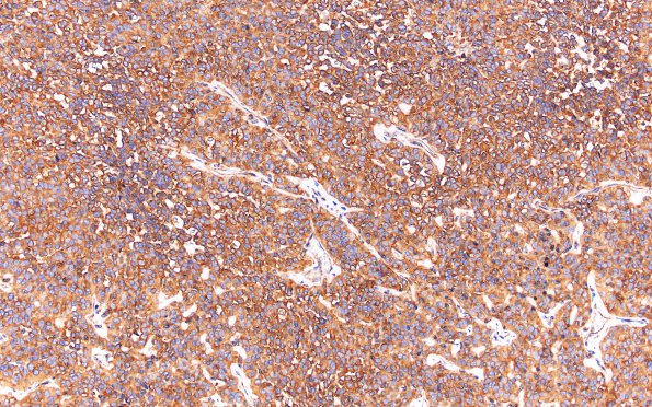 5B7 Meningioma, papillary (Case 5) EMA 20X 1