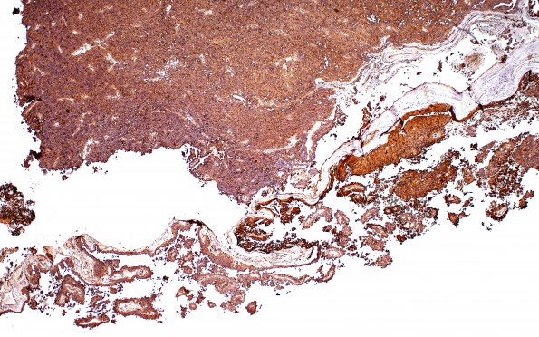 5C1 Meningioma, papillary (S98-36019) (VIM IHC) 4X