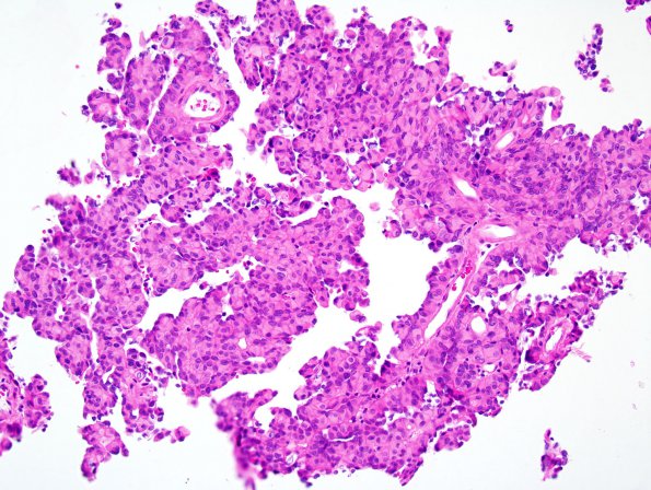 6A1 Meningioma, Papillary (Case 6) H&E 3.jpg