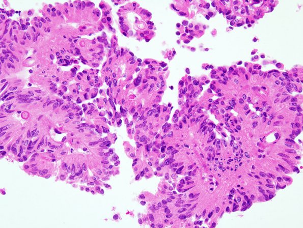 6A2 Meningioma, Papillary (Case 6) H&E 5.jpg