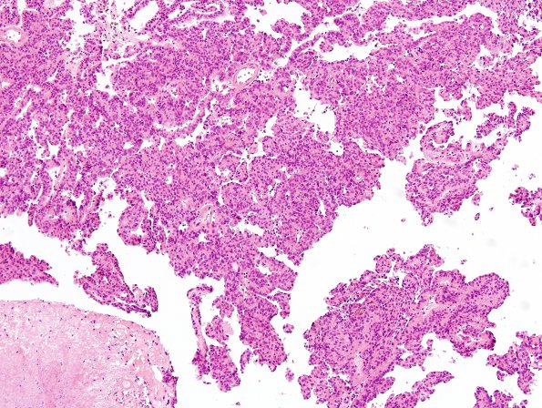 6A3 Meningioma, Papillary (Case 6) H&E 6 (2).jpg