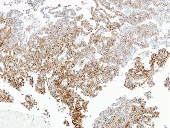 6B2 Meningioma, Papillary (Case 6) EMA 3.jpg