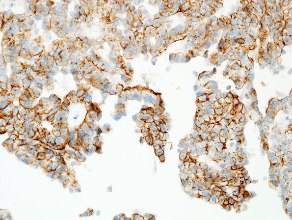 6B3 Meningioma, Papillary (Case 6) EMA 1 (2).jpg