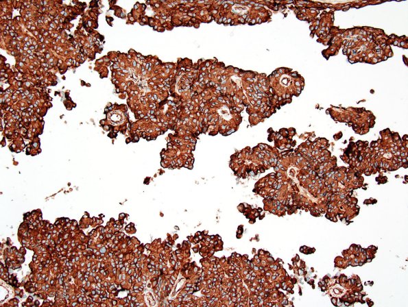 6C Meningioma, Papillary (Case 6) VIM 2.jpg