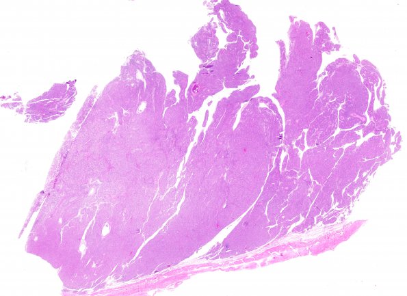 7A1 Meningioma, papillary (Case 7) H&E WM 2