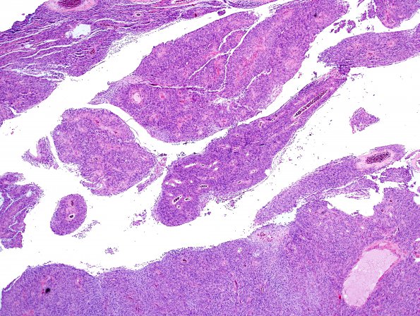 7A2 Meningioma, papillary (Case 7) H&E 9.jpg