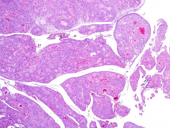 7A3 Meningioma, papillary (Case 7) H&E 11.jpg