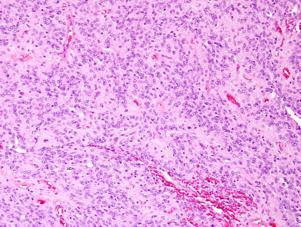 7A5 Meningioma, papillary (Case 7) H&E 4.jpg