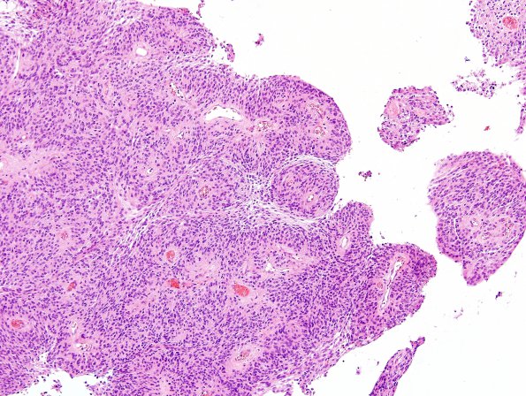 7A6 Meningioma, papillary (Case 7) H&E 1.jpg