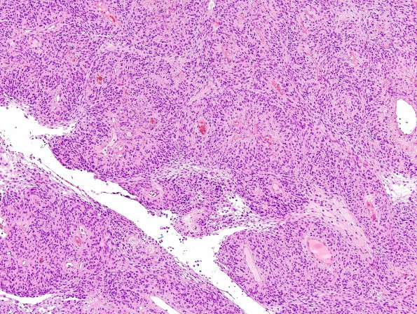 7A7 Meningioma, papillary (Case 7) H&E 2.jpg