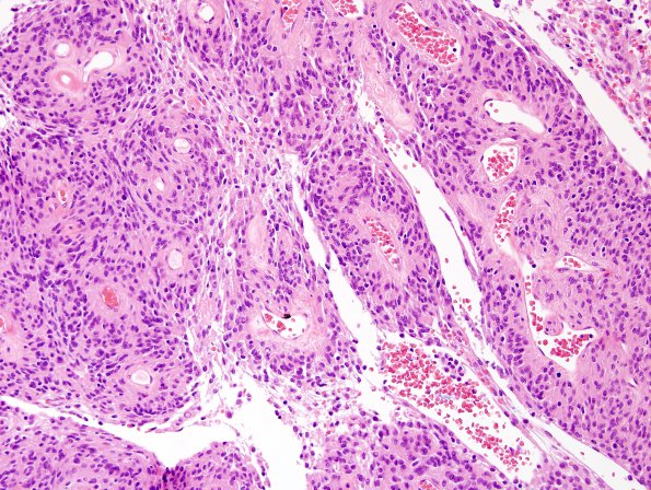 7A8 Meningioma, papillary (Case 7) H&E 3.jpg