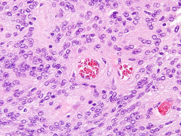 7A9 Meningioma, papillary (Case 7) H&E 17.jpg