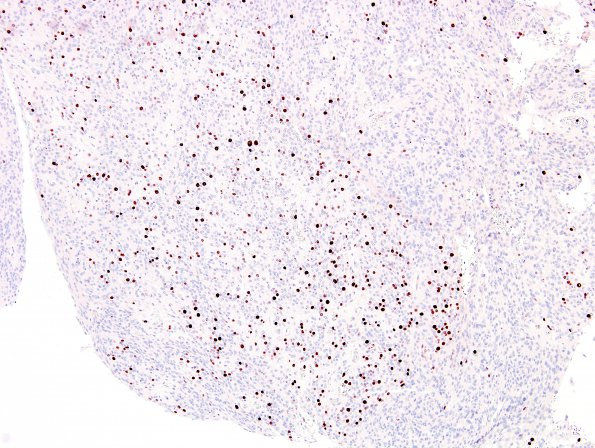 7B Meningioma, papillary (Case 7) Ki67 2.jpg