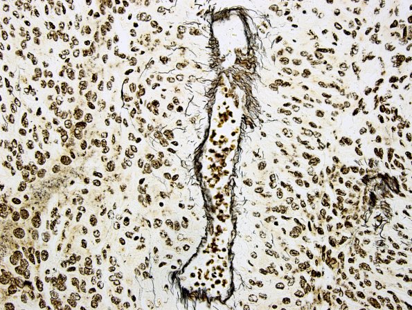 7C Meningioma, papillary (Case 7) Retic 1