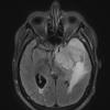 8A1 Meningioma, with papillary features, WHO II (Case 8) Flair 1 - Copy