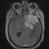 8A2 Meningioma, with papillary features, WHO II (Case 8) T1W 1 - Copy