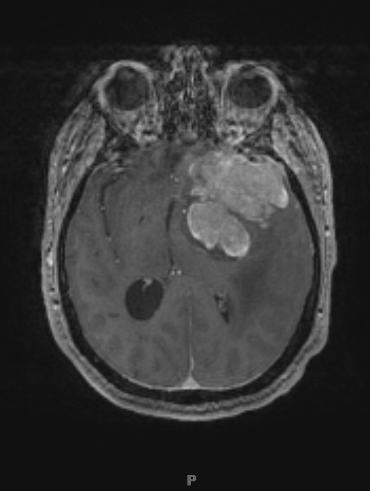 8A2 Meningioma, with papillary features, WHO II (Case 8) T1W 1 - Copy