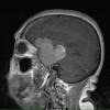 8A3 Meningioma, with papillary features, WHO II (Case 8) T1W 2 - Copy