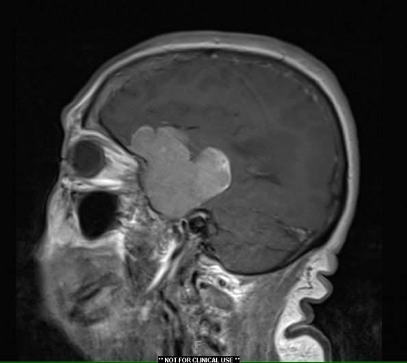 8A3 Meningioma, with papillary features, WHO II (Case 8) T1W 2 - Copy