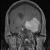 8A4 Meningioma, with papillary features, WHO II (Case 8) T1W 3 - Copy