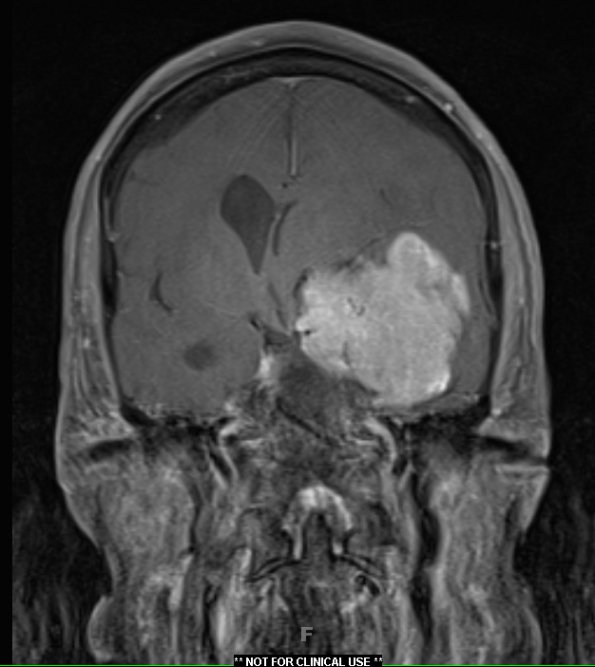 8A4 Meningioma, with papillary features, WHO II (Case 8) T1W 3 - Copy