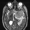 8A5 Meningioma, with papillary features, WHO II (Case 8) T2W 1 - Copy