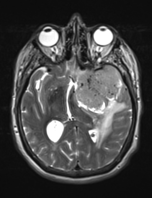 8A5 Meningioma, with papillary features, WHO II (Case 8) T2W 1 - Copy