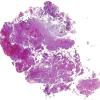 8B1 Meningioma, with papillary features, WHO II (Case 8) H&E WM