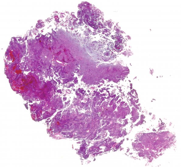 8B1 Meningioma, with papillary features, WHO II (Case 8) H&E WM