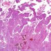 8B2 Meningioma, with papillary features, WHO II (Case 8) H&E 1.jpg