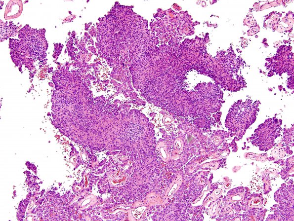 8B3 Meningioma, with papillary features, WHO II (Case 8) H&E 5.jpg