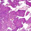 8B4 Meningioma, with papillary features, WHO II (Case 8) H&E 6.jpg