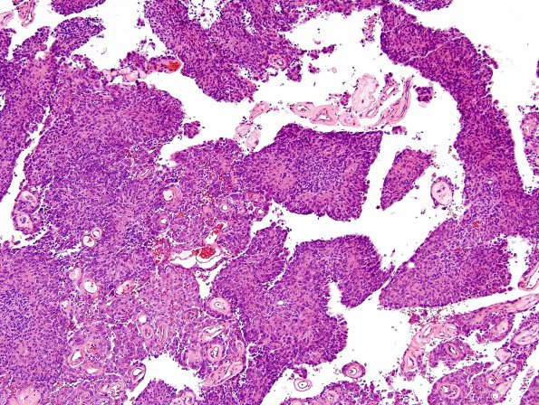 8B4 Meningioma, with papillary features, WHO II (Case 8) H&E 6.jpg