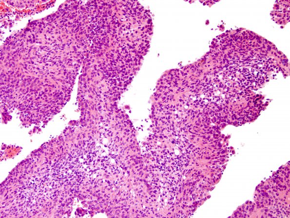 8B5 Meningioma, with papillary features, WHO II (Case 8) H&E 7.jpg