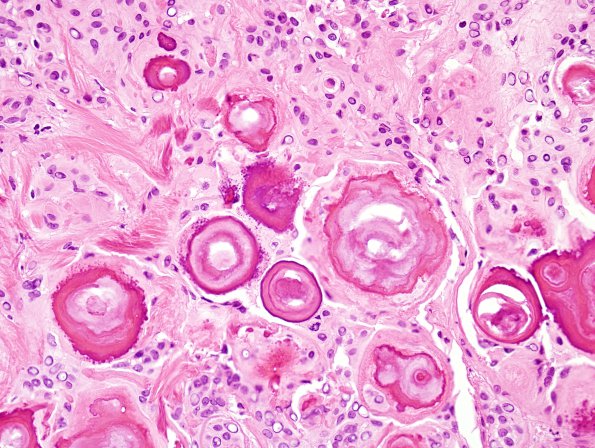 10A2 Meningioma, psammomatous (Case 10) H&E 3