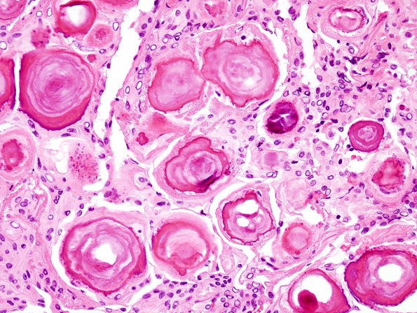 10A3 Meningioma, psammomatous (Case 10) H&E 2