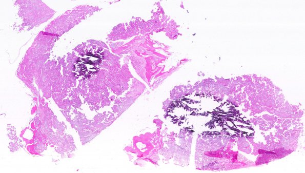 11A1 Meningioma, psammomatous (Case 11) WM cropped 2