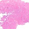 11A2 Meningioma, psammomatous (Case 11) 2X