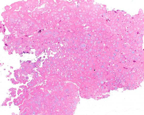 11A2 Meningioma, psammomatous (Case 11) 2X